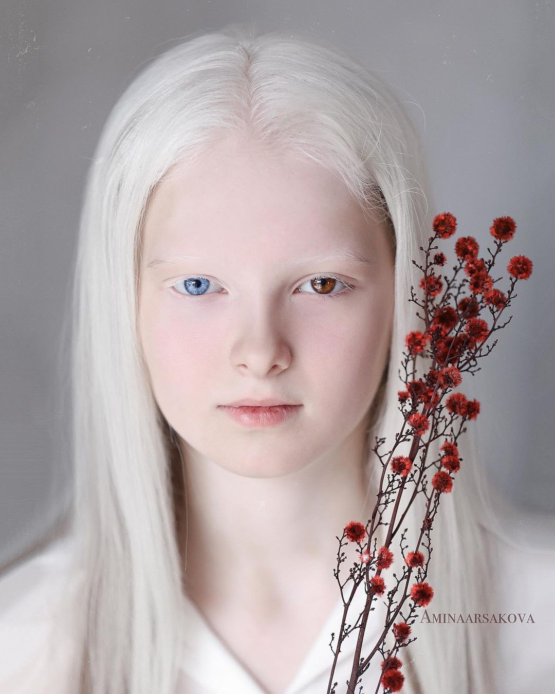 Амина Эпендиева: невероятная девочка-альбинос с разноцветными глазами из Чечни. Как выглядит сегодня и потеряла ли красоту 1